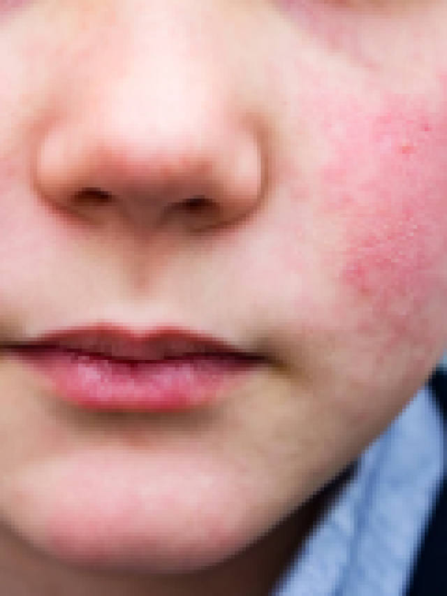 Cases of parvovirus rising in the U.S